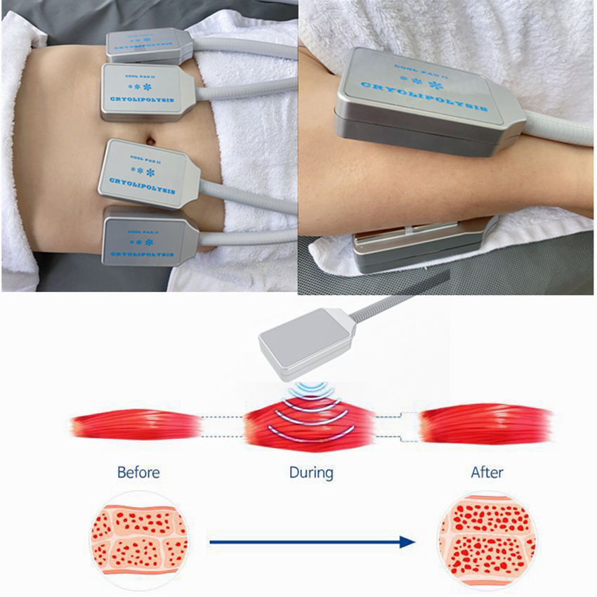 Freezing fat cell slimming on body belly fat loss fat freezing liposuction Electric Muslce Stimulaiton for cellulite
Freezing fat cell slimming on body belly fat loss fat freezing liposuction Electric Muslce Stimulaiton for cellulite