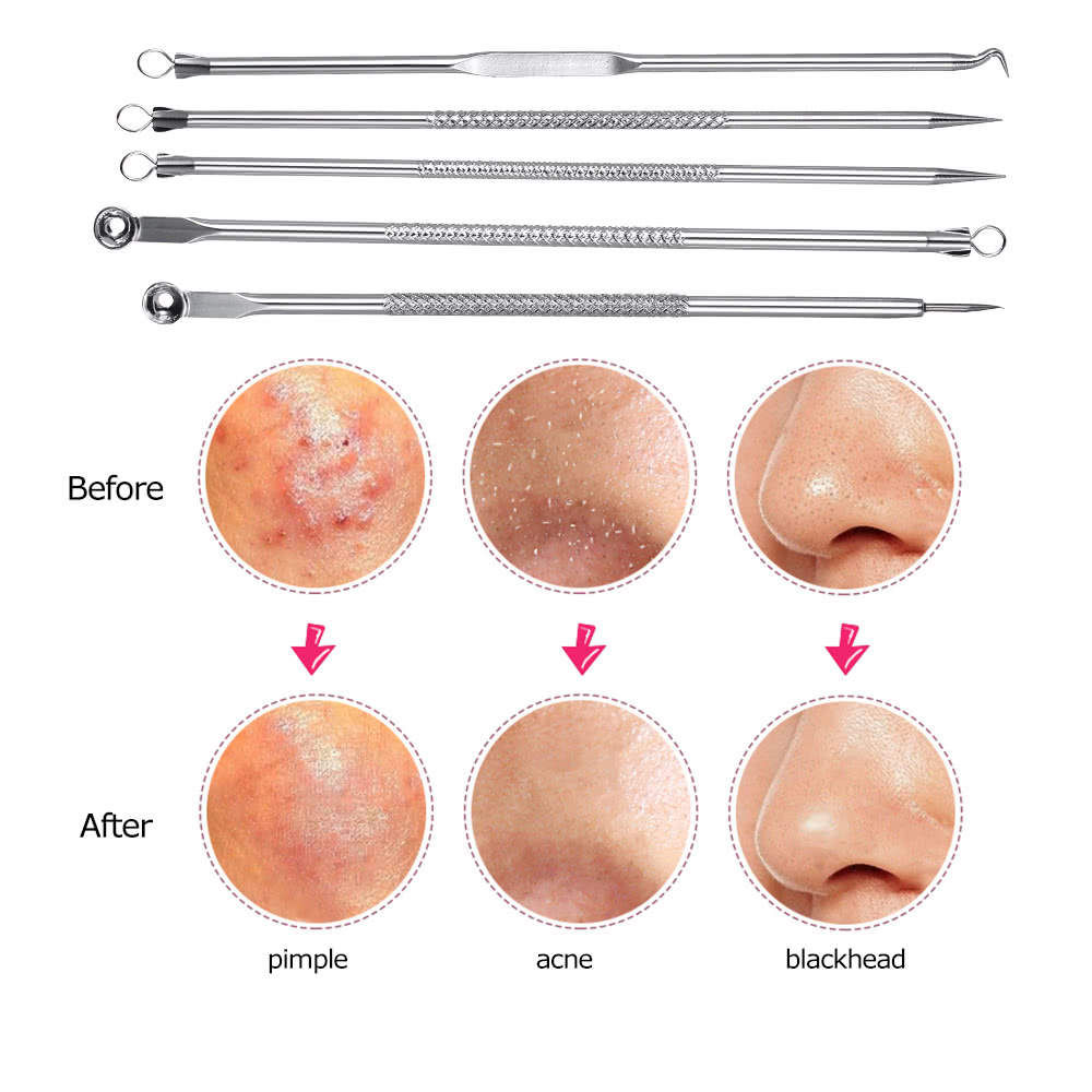 5PCS Stainless Blackhead Comedone Remover Needle Blemish Pimple Pin Acne Extractor Face Clean Tool