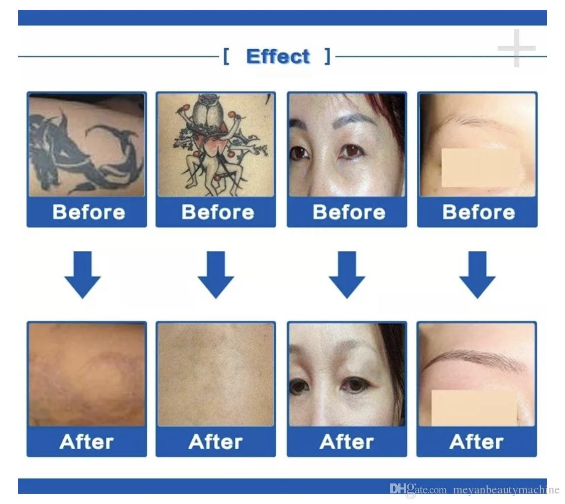 2020New Professional picosecond laser tattoo removal machine Co2 Q&Switch high-power eyebrow washing spots Remove Laser machine Free shippin