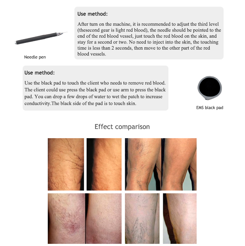 Good quality Vascular spider veins removalvein remove machine