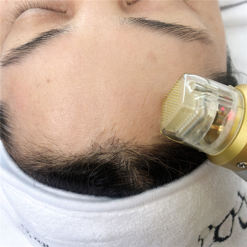 Mini Home Use RF Micro Needle Fractional Face Lift Skin Rejuvenation Device RF Face Lifting Machine
Mini Home Use RF Micro Needle Fractional Face Lift Skin Rejuvenation Device RF Face Lifting Machine