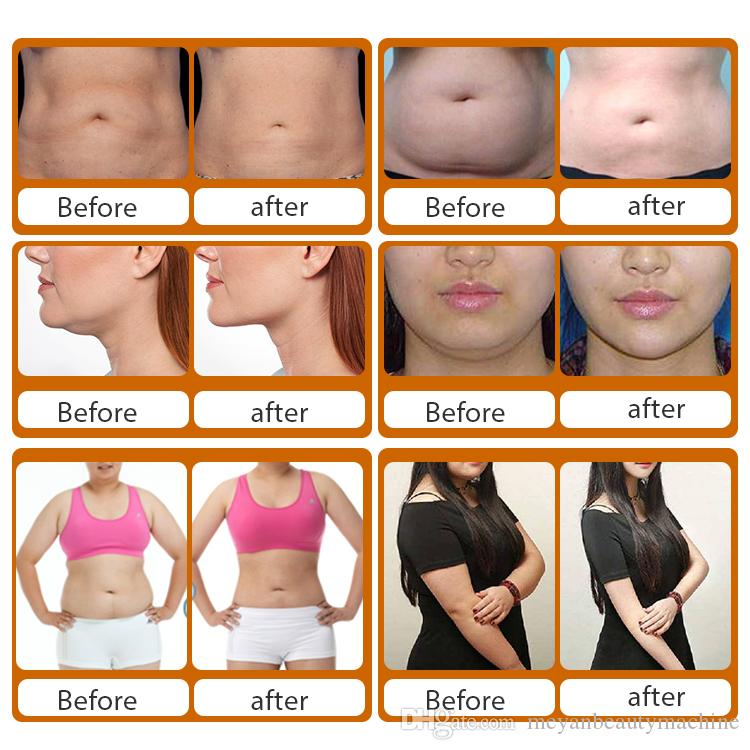 Newest 3 cryo handle cryolipolysis cryotherapy 800W ultrasonic vacuum lipo weight loss laser fat freezing shaping cavitation beauty machine