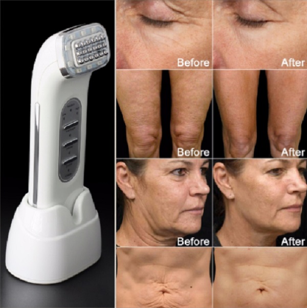 Real Remove Wrinkles Dot Matrix Facial Radio Frequency Lifting Face Lift Body SKin Care Beauty Device 110-240V