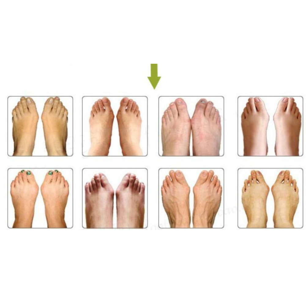 Silicone Toe Separator Bunion Splint Hallux Orthosis Correction Overlapping Spreader Foot Protector Inserts Toe Care Separador De Dedos De Silicona Wh