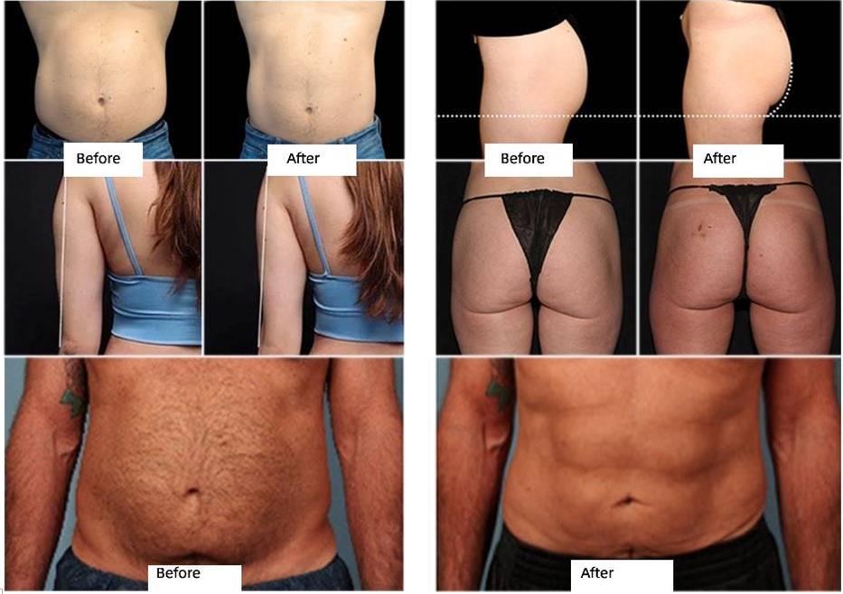 EMS Electromagnetic Muscle Buiding Abs Training Fat Removal Body Sliming Machine Butt Lifting Emslim Body Sculptor
