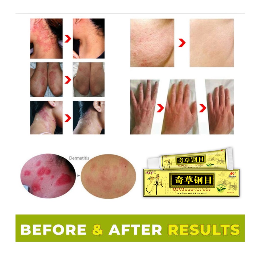 Itching Eczema Pruritus Psoriasis herbal cream home Treatment 20g ointment body foot care PiYanPing
Itching Eczema Pruritus Psoriasis herbal cream home Treatment 20g ointment body foot care PiYanPing