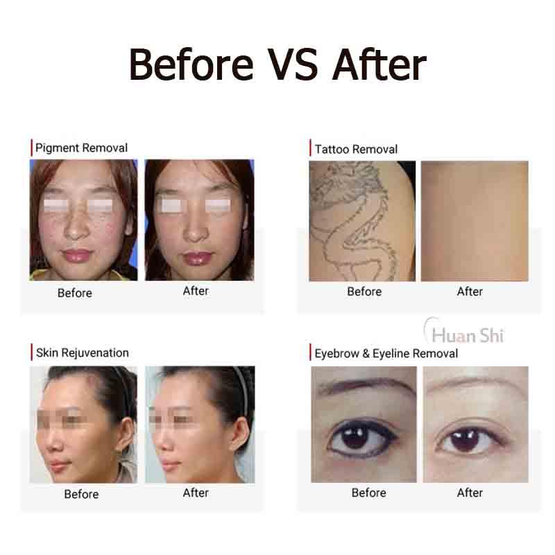 Picosecond for All Skin Type Tattoo Removal Q Switch Laser 1064nm 532nm 755nm Tatoo Pigment freckle sun spot Remoel Machine