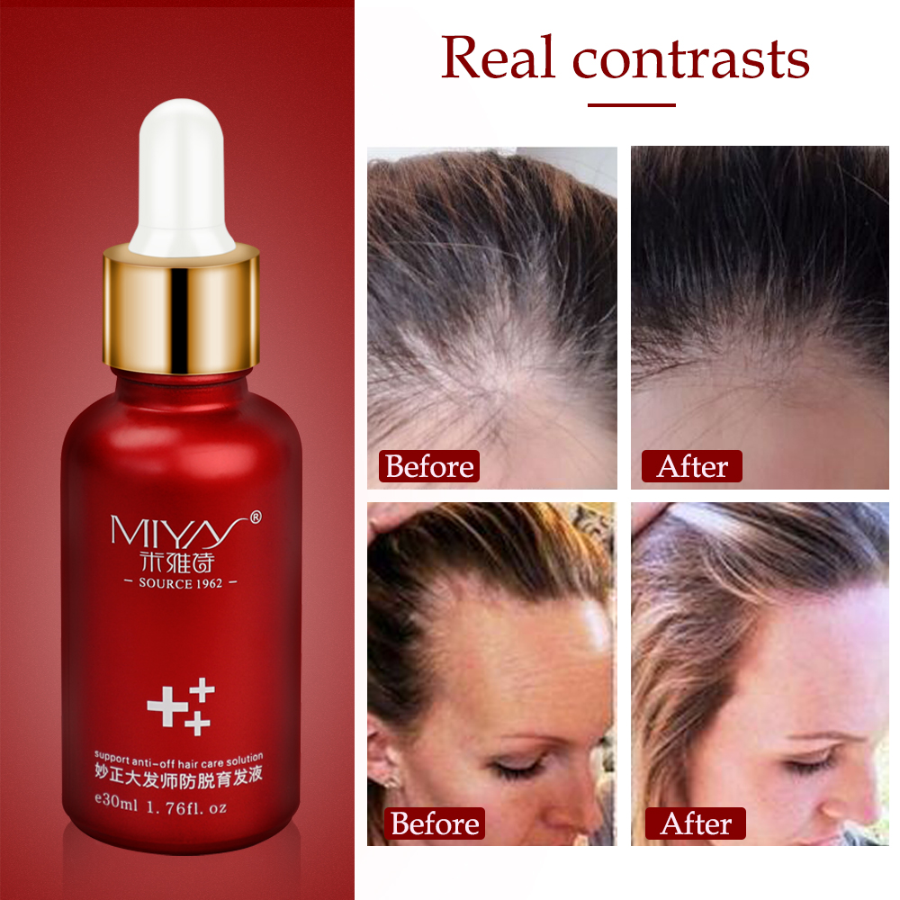 Hair Growth Essence Oil Spray Fast Hair Growth Natural Anti Hair Loss Treatment Solution Care Products TonicScouts
Hair Growth Essence Oil Spray Fast Hair Growth Natural Anti Hair Loss Treatment Solution Care Products TonicScouts