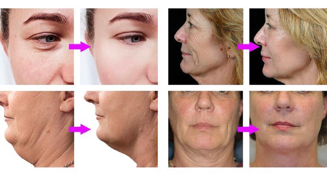 Mini Hifu Face Lifting and Firming RF Apparatus for Beauty Salon