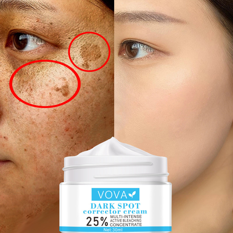 Whitening Freckle Face Cream Effective Remove Melasma Acne Spot Pigment Melanin Dark Spots Pigmentation Moisturizing Skin Care
Whitening Freckle Face Cream Effective Remove Melasma Acne Spot Pigment Melanin Dark Spots Pigmentation Moisturizing Skin Care