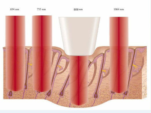 5 Years warranty!!! Professional High Quality Good effects Painfree Permanent Hair Removal 808nm Diode Laser Hair Removal Machines