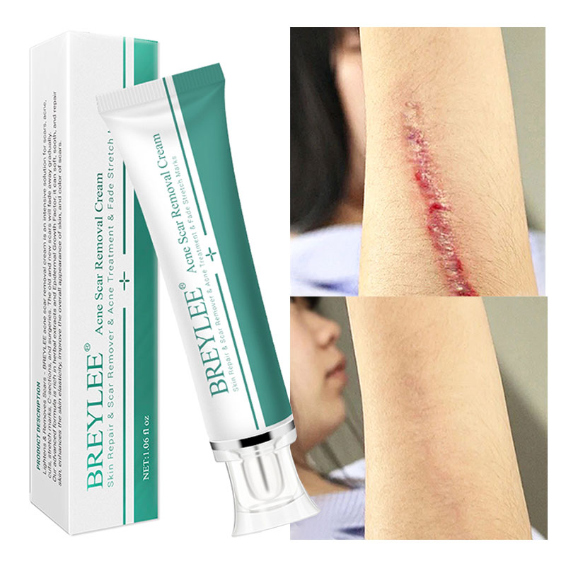 BREYLEE Scar Removal Cream Face Cream Scar Stretchmarks Spots Remover Cream Skin Repair Acne Treatment Whitening Body 30g
BREYLEE Scar Removal Cream Face Cream Scar Stretchmarks Spots Remover Cream Skin Repair Acne Treatment Whitening Body 30g