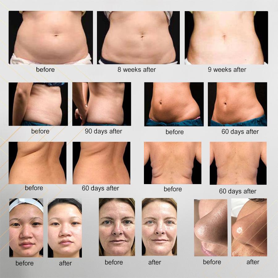 Slimming Machine 6 In 1 Ultrasonic Cavitation Body Shaping Radio Frequency Liposuction Machine