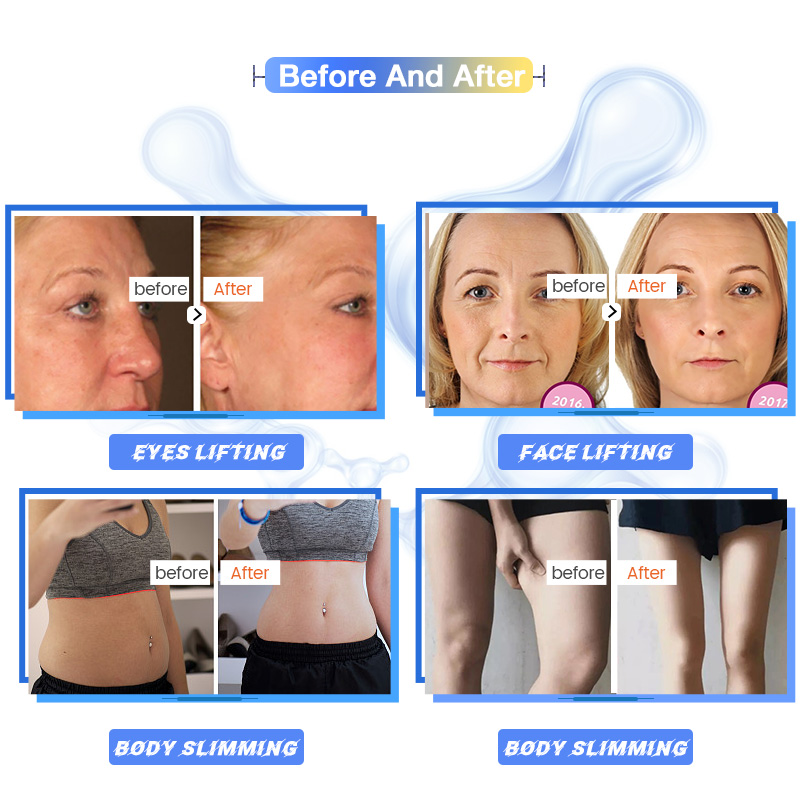 Upgraded 7D HIFU Face Lifting Machine SMAS Skin Tightening Wrinkle Removal Treatment Hifu Therapy Ultrasound Devices