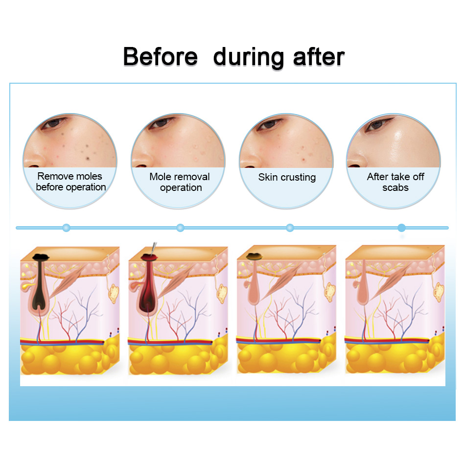 9 Level Tattoo Mole Removal Machine Laser Plasma Pen Dark Spot Remover LCD Skin Care Point Pen Skin Wart Tag Beauty CareScouts
9 Level Tattoo Mole Removal Machine Laser Plasma Pen Dark Spot Remover LCD Skin Care Point Pen Skin Wart Tag Beauty CareScouts