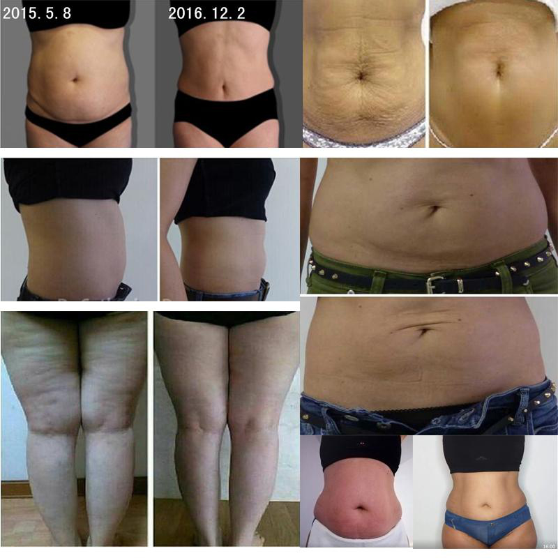 Cryolipolysis fat free machine ultra cavitation body rf lipolysis slim diode laser cellulite reduce 360 cryo facial machines 7 in 1