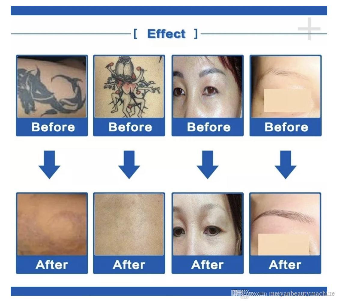 2022 picos second laser tattoo removal machine portable nd yag laser picosecond 3 probes pigmentation removal machine