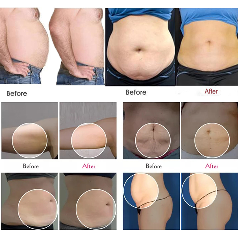 V10 ultrasonic vacuum roller massage cellulite reduction infrared laser slimming bio skin tightening rf body machine 5 handle