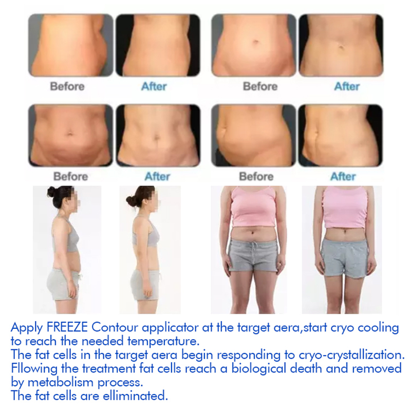 Cryolipolysis fat freeze Machine for Effective Fat Reduction - Double Chin Treatment Included