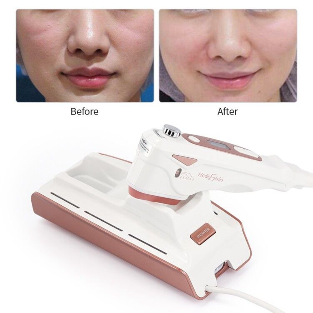 medical ultrasound devices women private mini hifu vaginal tightening machine hifu device home use face lifting