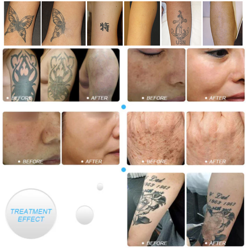2022 Picosecond Laser beauty system carbon peel laser machine tattoo remove fungos
