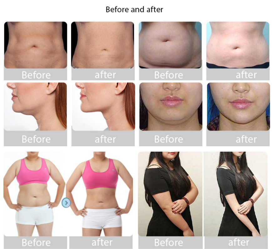 360 Cryolipolysis Slimming Machine Fat Removal Portable Cryolipolysis 360