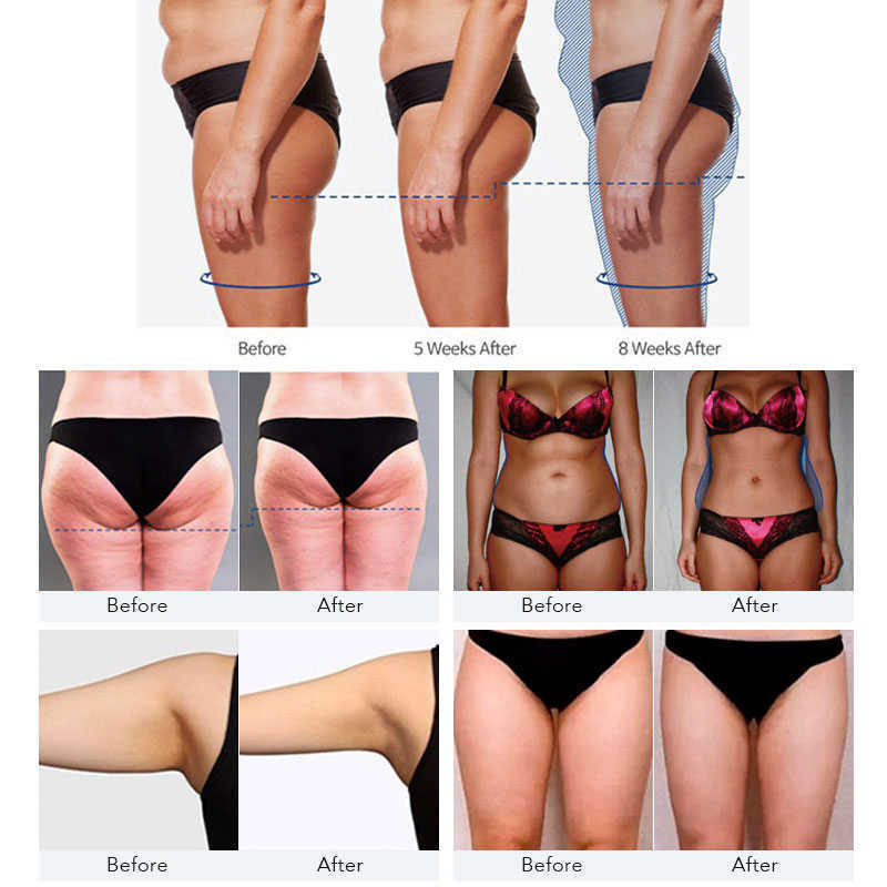 Emslim Hi-emt Machine Fat Burning Body Shaping Ems Electromagnetic Muscle Stimulation Buttocks Lifting Arm Thigh Abdomen Hiemt contouring