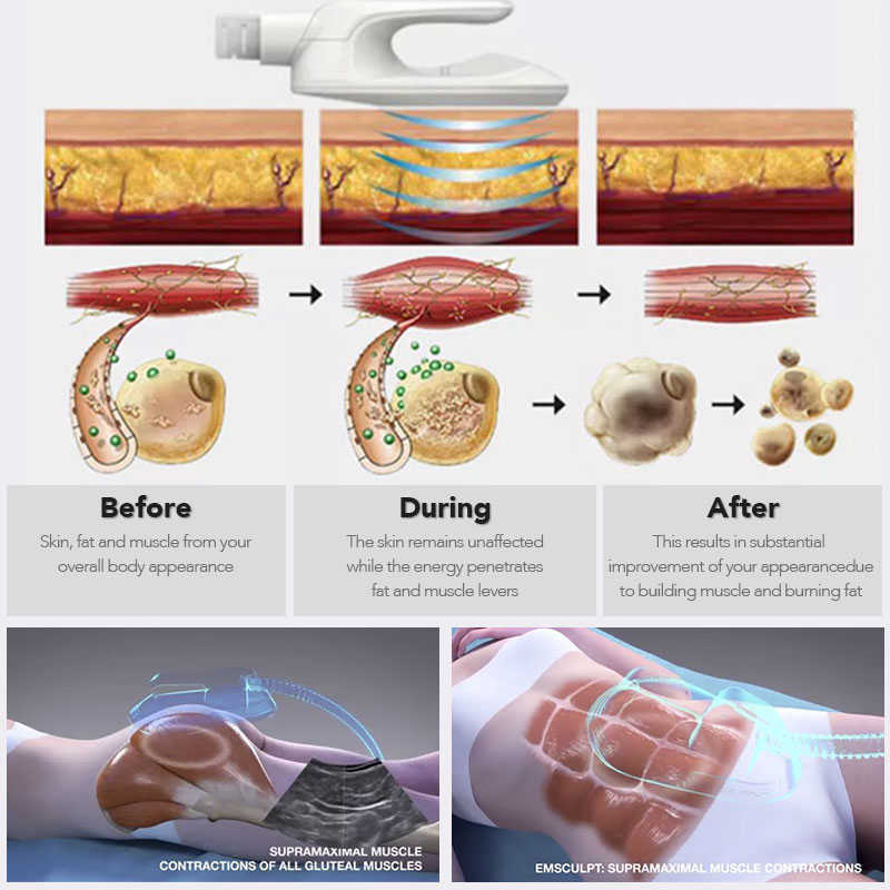 Emslim Hi-emt Machine Fat Burning Body Shaping Ems Electromagnetic Muscle Stimulation Buttocks Lifting Arm Thigh Abdomen Hiemt contouring