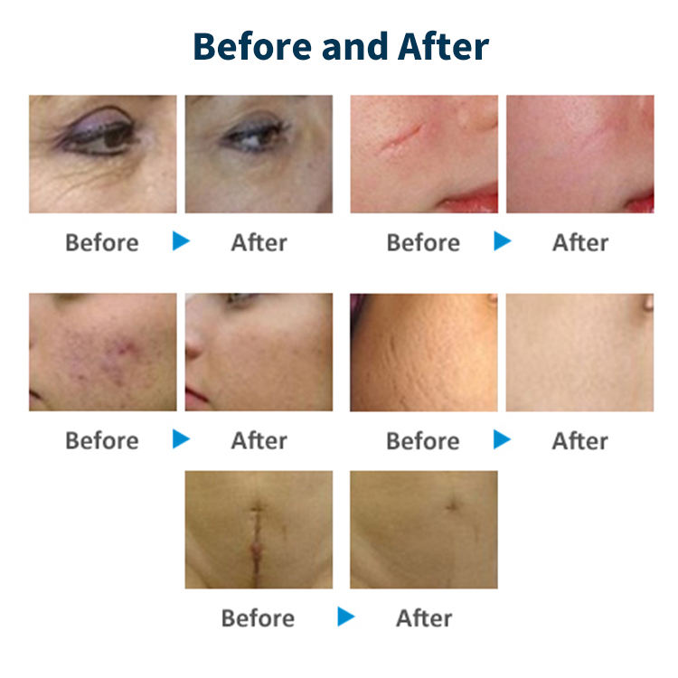 High quality Fractional Co2 Laser Machine / co2 fractional lasers equipment skin resurfacing