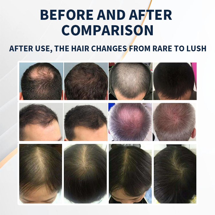 Laser Hair Growth System Laser Therapy Hair Growth Laser Machine Red Light Private Label