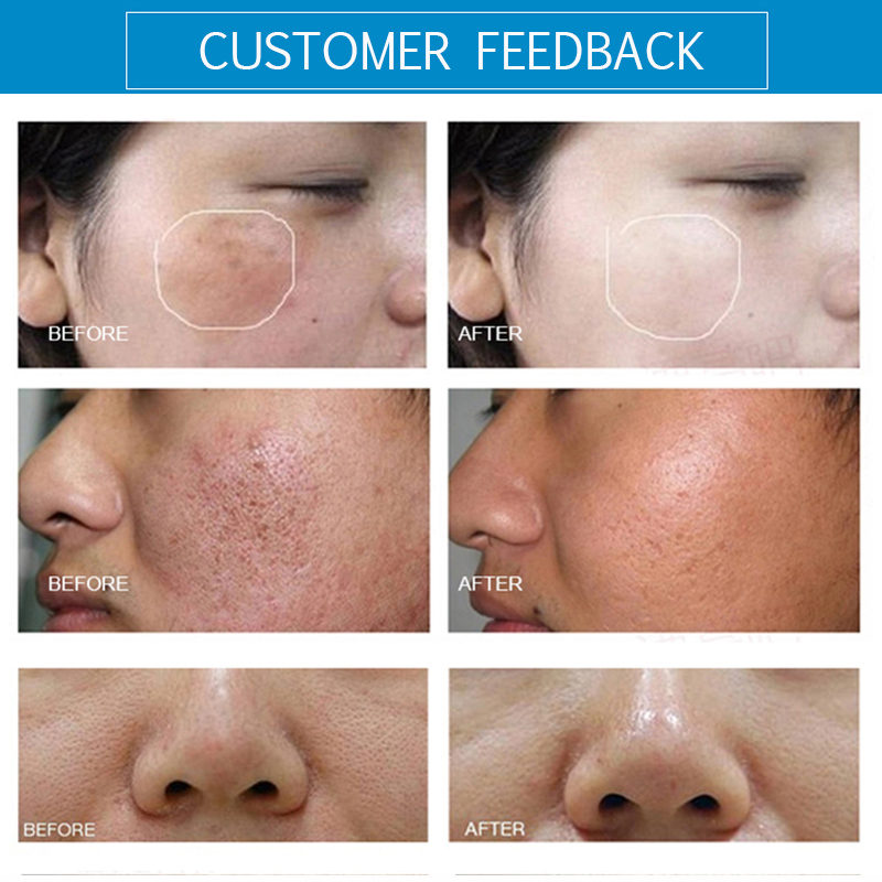 Hydro therapy microdermabrasion collagen ultrasound peel rf face beauty massage cold hammer galvanic facial machine 5 handle