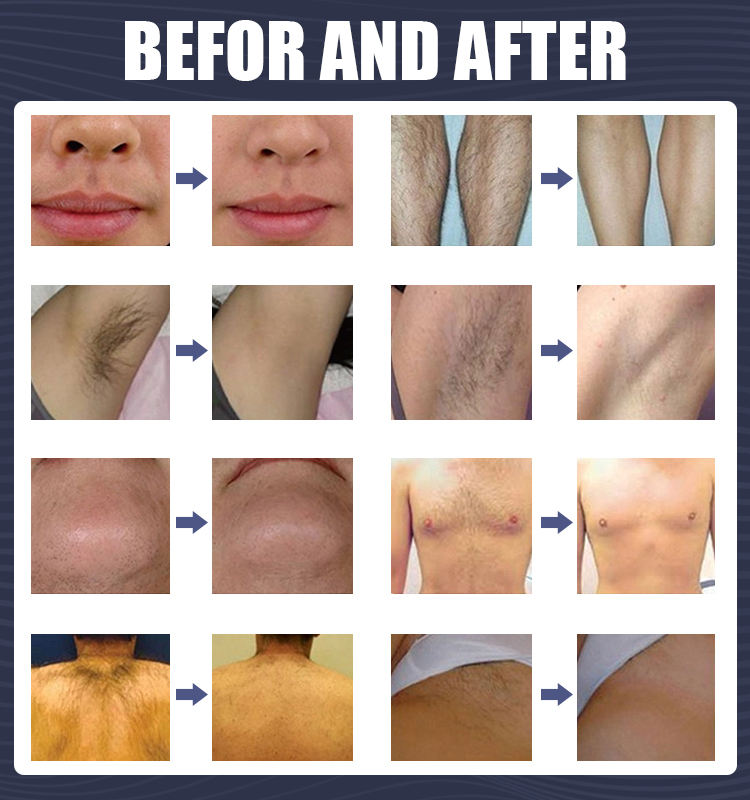 Laser Epilation 1000W Diode Laser Hair Removal Machine Diode-Laser 808nm