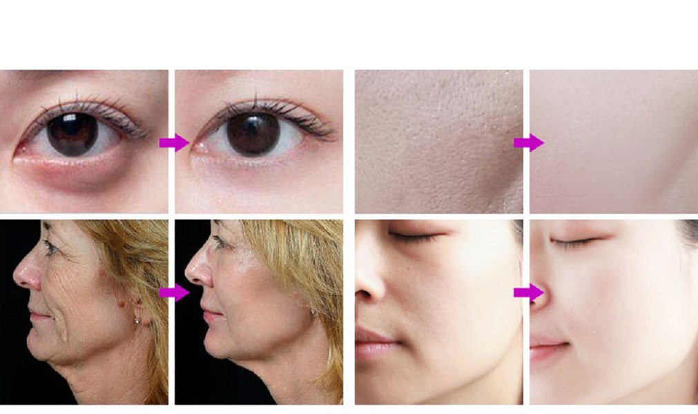9 in 1 Multifunctional Microdermabrasion Oxygen Facial Beauty Machine