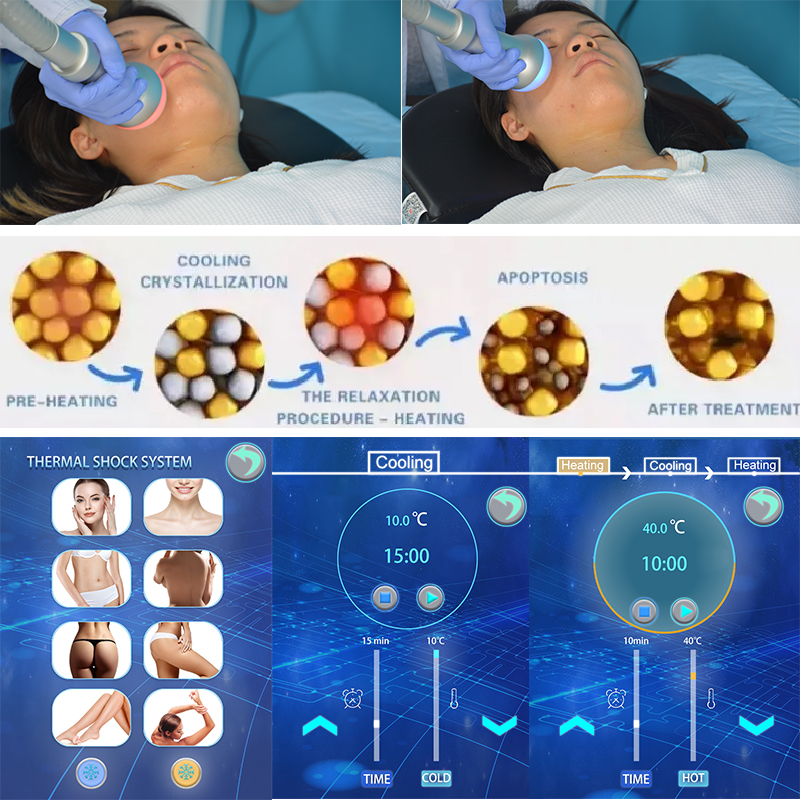 2 in 1 Cryoskin Thermal Shock slimming System Cryo skin Machine 2 Handles Skin tightening Body Sculpting Machine