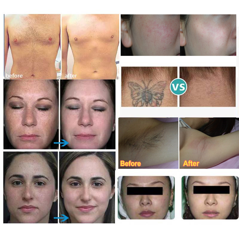 Aesthetics nd yag laser skin rejuvenation opt ipl machine hair removal elight pigmentation treatment rf wrinkle lifting machines 3 handle
