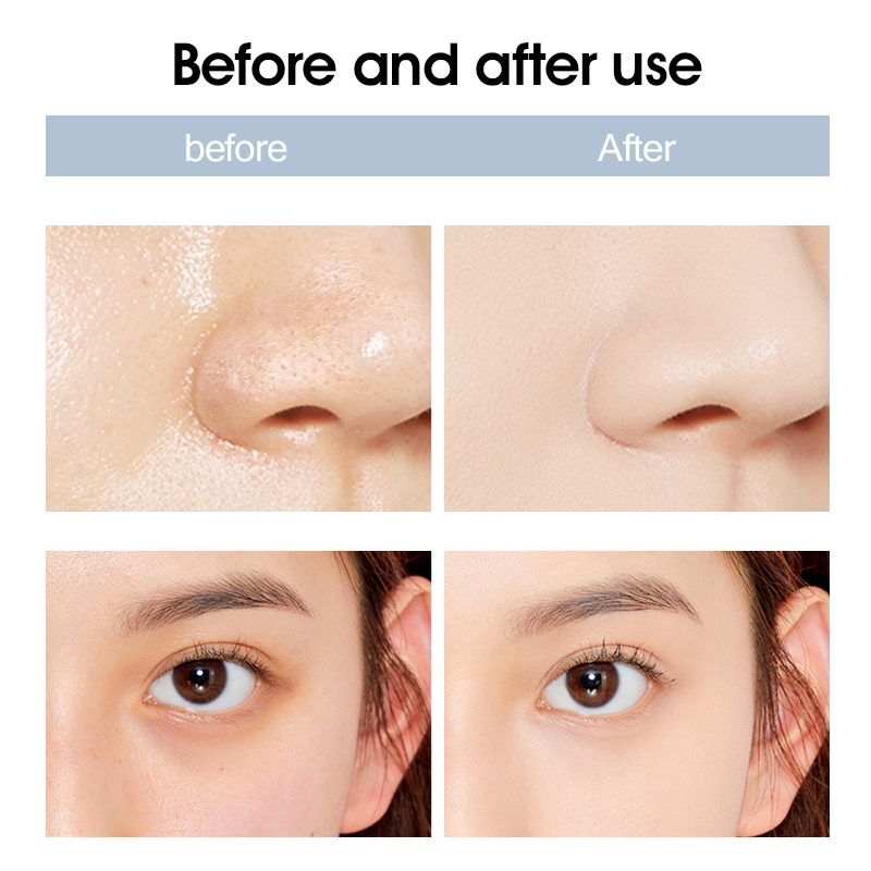 Blackhead removal face lifting acne treatment RF Microdermabrasion beauty device facial skin rejuvenation moisturizing winkles remove anti aging equip