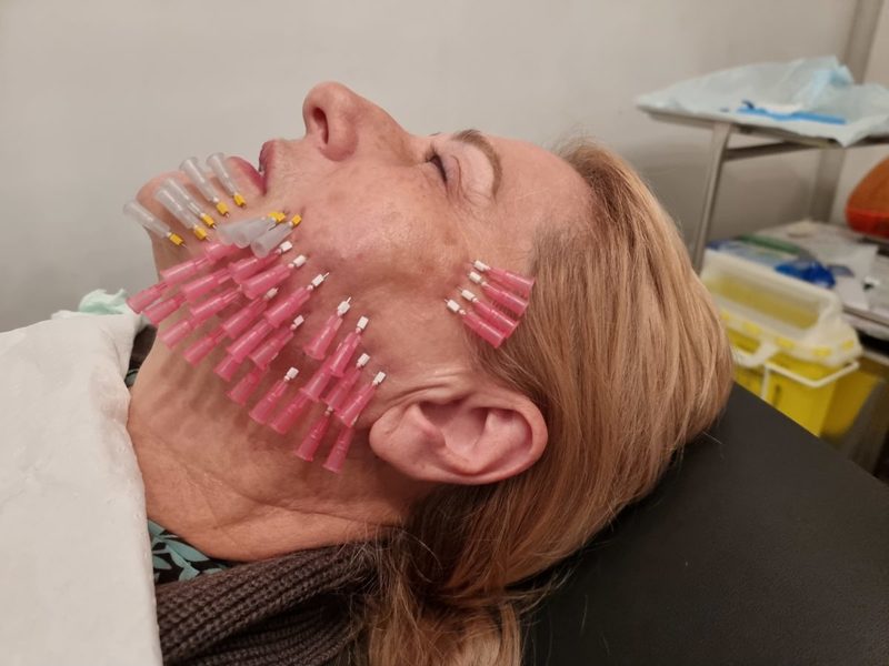 20Pcs 30 Pcs 50Pcs Pdo Pcl Plla Mono 29G38mm For Face Lifting Mono Screw 26g90mm Pdo Threads Lift For Neck LIFT 220526304C
20Pcs 30 Pcs 50Pcs Pdo Pcl Plla Mono 29G38mm For Face Lifting Mono Screw 26g90mm Pdo Threads Lift For Neck LIFT 220526304C