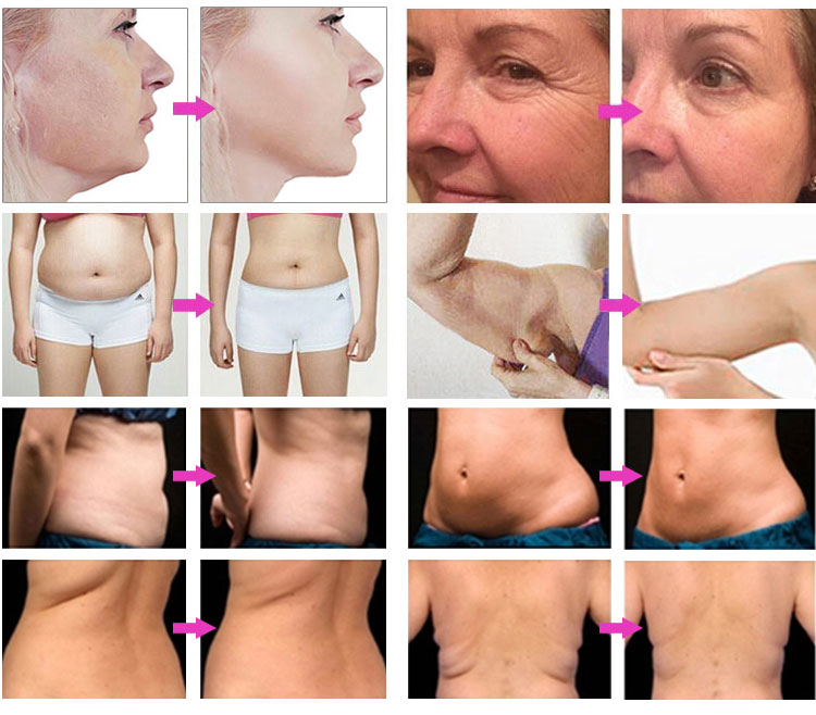 Face Lift Eyebag Wrinkle Remover Skin Tightening Machine Body Shape Cellulite Reduction Slimming Beauty Device