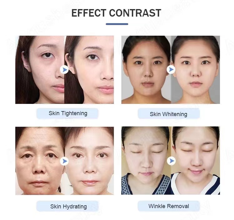 EMS transdermal skin care face lifting micro nano needle free and rf water mesotherapy home use device