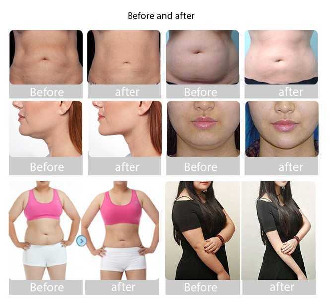 V5 Pro RF Body Slimming Beauty Machine Focused Ultrasound Beauty Equipment