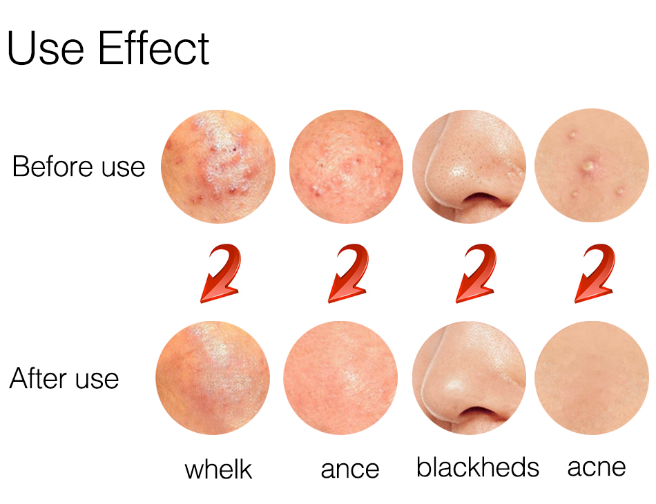 Free Shipping 8pcs Professional Blackhead and Blemish Remover Kit Blackheads Extractor Comedone Extractors Blemish Case with Mirror