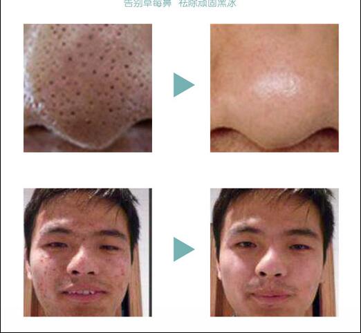 New Model dermabrasion water peeling oxygen inject machine BIO RF skin care machine