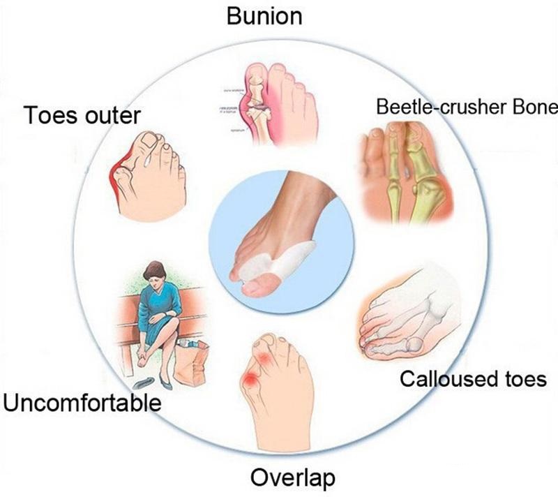 Toe Hallux Valgus Corrector Silicone Gel Spreader Feet Care Toe separator Bunion Guard Toe Stretcher Straightener Zehen-Hallux-Valgus-Korrektor Wholes
