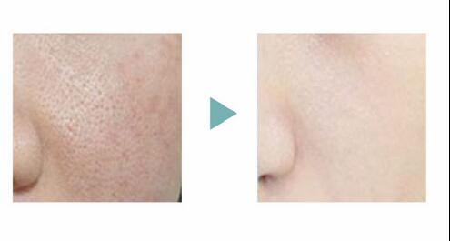 New Model dermabrasion water peeling oxygen inject machine BIO RF skin care machine