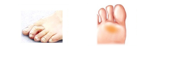 Feet Care Hallux Valgus Orthopedic Metatarsal Crooked Overlapping Hammer Toe Straightener Corrector Foot Massager Orthopedic Supplies