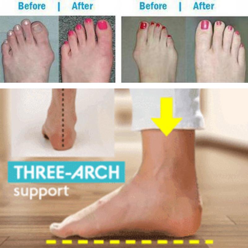 vertvie Women Shoes Slippers Orthopedic Bunion Corrector Comfy Platform Ladies Casual Big Toe Correction Sandal