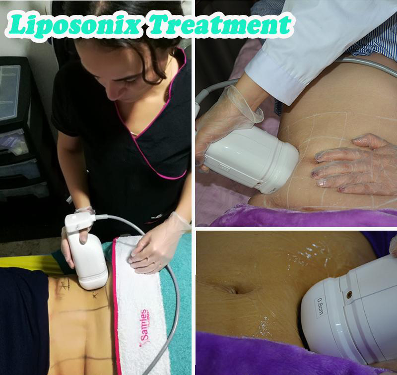 Liposonix slimming machine price cellulite removal home salon spa use hifu machines lipohifu Ultrasound liposonic equipment