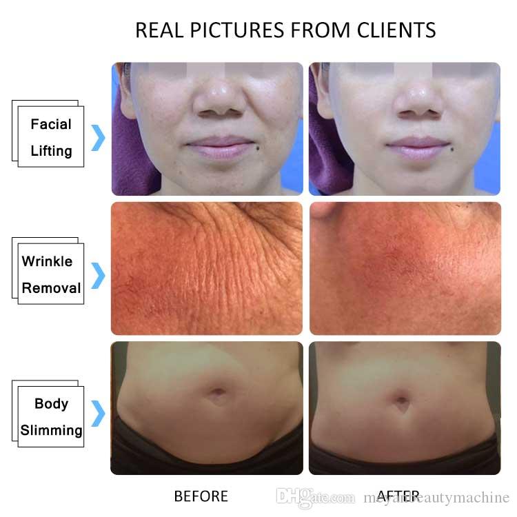 Winkonlaser 25000 shots 4d Hifu Professional Ultrasound Body Slimming Hifu / Face Lift Hifu Machine With Ce