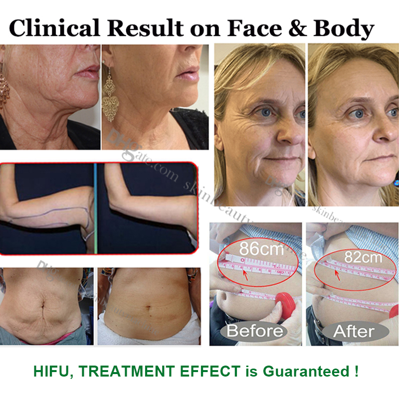 Face Lift 3D HIFU Machine 9d High Intensity Focused Ultrasound Wrinkle Removal Beauty Equipment Fda Ce Approved