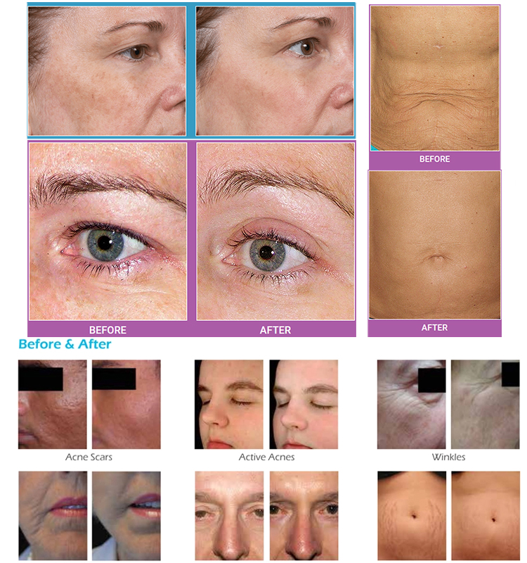 Radio Frequency Microneedling Fractional RF Facial Machine Stretch Marks Removal Skin Tighten Wrinkles Reduction Microneedle Anti Aging Remove Acne Sc